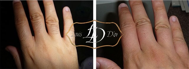 До и после лазерной эпиляции пальцев рук