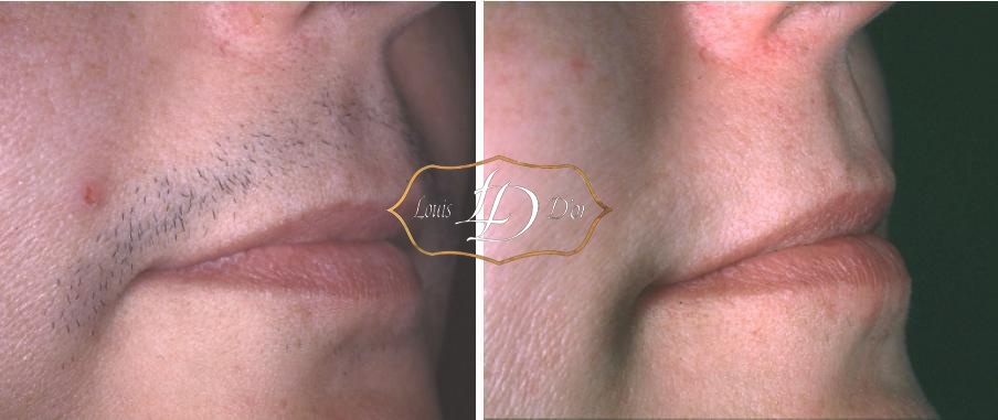 До и после лазерной эпиляции верхней губы